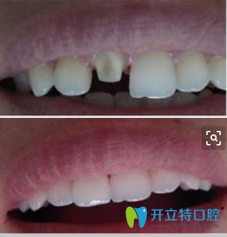 二氧化鋯全瓷牙修復前后對比效果