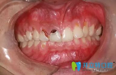 怎么預(yù)防可樂(lè)牙