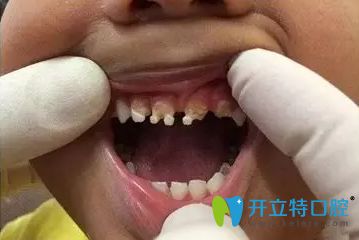 可樂(lè)牙圖片