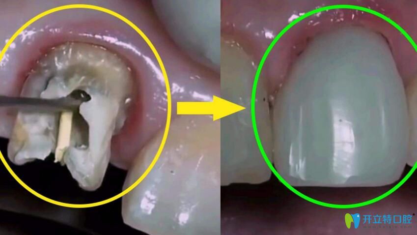 牙齒碎裂后該怎么辦呢？有哪些方法可以補(bǔ)救