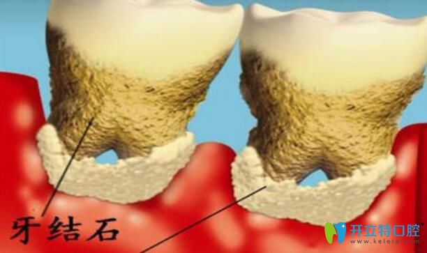 牙齒破碎脫落什么原因以及牙齒破碎后的修復方法公布