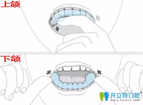 摘隱形牙套圖解