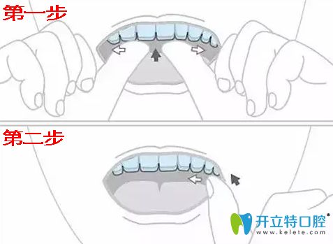戴隱形牙套步驟圖解