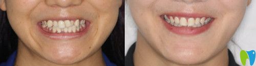 陶瓷自鎖托槽矯正技術