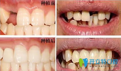 武漢清華陽(yáng)光口腔王多英單顆牙種植效果圖