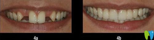 進口種植牙前后效果圖