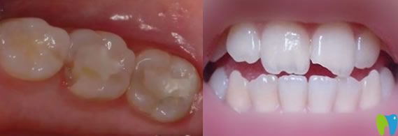 牙齒缺了一小塊怎么辦