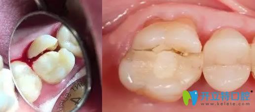 牙齒缺了一塊需要補(bǔ)嗎