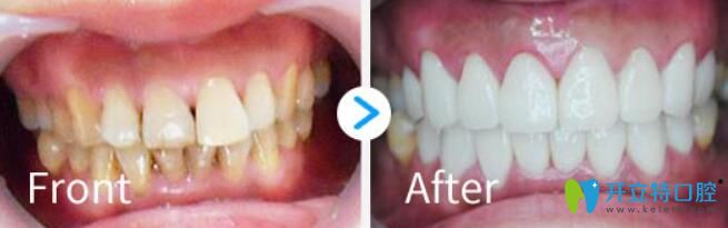 柯明瓷貼面修復(fù)四環(huán)素牙案例