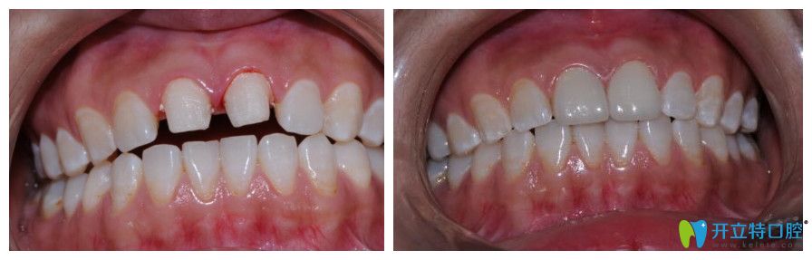 門牙大該怎么辦呢