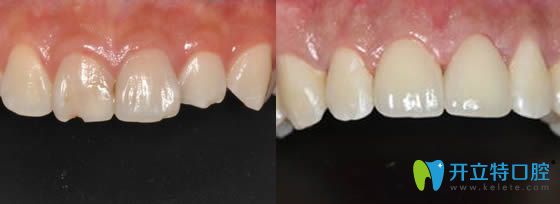 無(wú)錫北極星口腔姚凱牙體修復(fù)效果對(duì)比圖