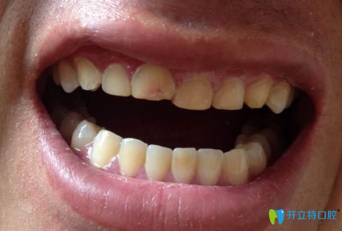 門牙太大、太長可以磨小嗎