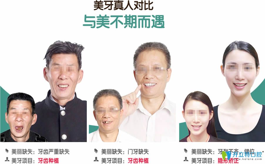 無(wú)錫北極星口腔種植牙真人效果對(duì)比圖
