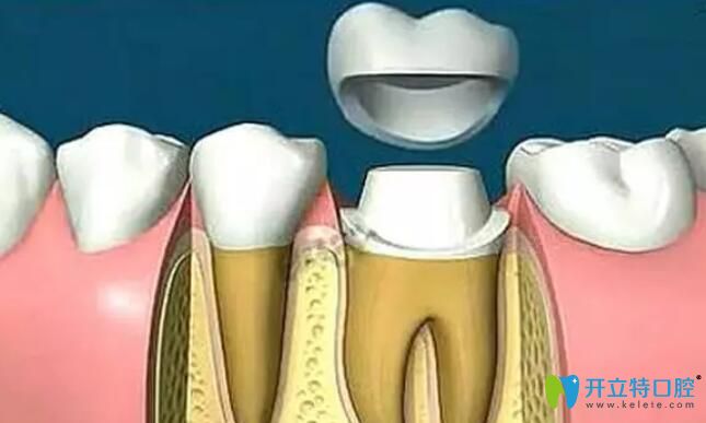 牙齒開(kāi)裂該如何治療