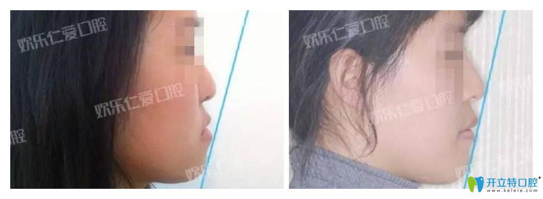 沈陽歡樂口腔怎么樣？肖春正畸案例公布