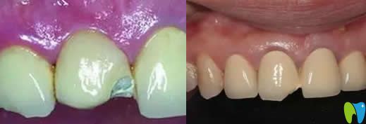 烤瓷牙崩瓷了怎么辦?真相烤瓷牙壞了能不能修復(fù)及有沒有毒