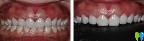 全瓷貼面后牙齒效果圖 全瓷貼面后牙齒效果圖