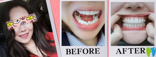 東莞哪里矯正牙齒好？東莞好百年口腔牙齒不齊矯正案例來(lái)證明
