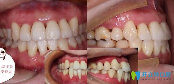 廈門登特口腔隱形牙齒矯正前后效果對比圖
