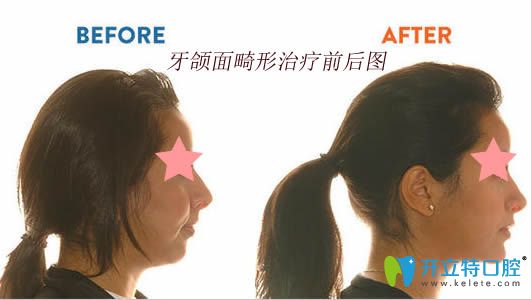 牙頜面畸形矯治前后對比圖