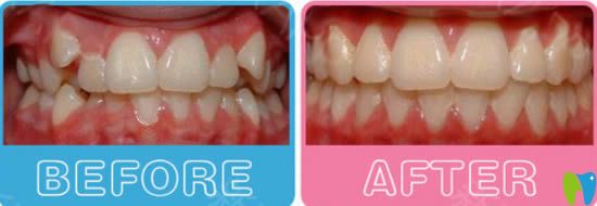 武漢清華陽光口腔牙齒擁擠+虎牙矯正后對比照