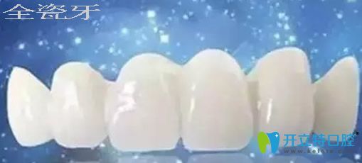全瓷烤瓷牙