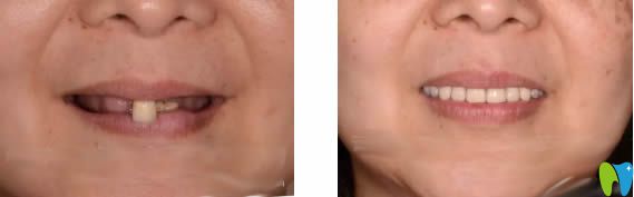 武漢清華陽光口腔3D導板種植牙前后對比效果