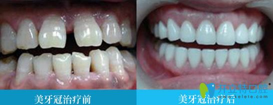 牙齒美容冠修復(fù)前后對比圖