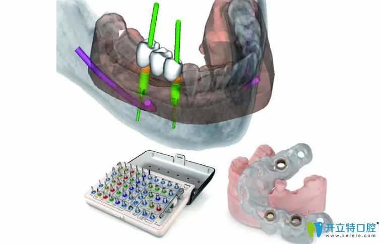 3d導板定位種植技術優(yōu)勢