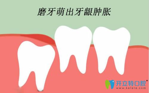 兒童長磨牙牙齦腫破需要怎么處理嗎？