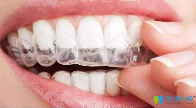 隱適美隱形牙套圖示