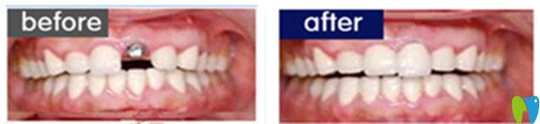 單顆牙齒缺失效果圖