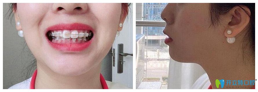 格倫菲爾口腔體驗(yàn)半隱形冰晶托槽矯正4個(gè)月效果圖