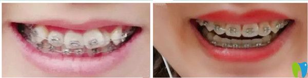 吉林愛齒口腔牙齒矯正前后對(duì)比圖