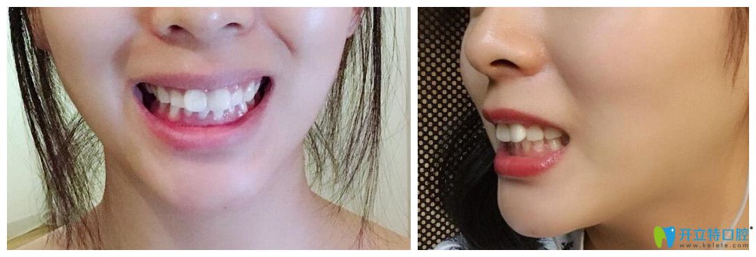 在格倫菲爾口腔體驗(yàn)半隱形冰晶托槽矯正