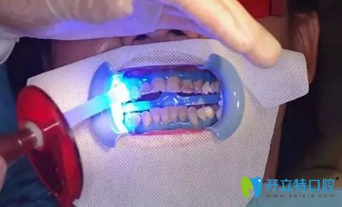 冷光牙齒美白
