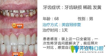 南京博韻口腔周光正靠譜嗎？美容冠修復(fù)案例公布