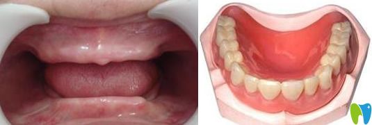 全口牙缺失怎么辦