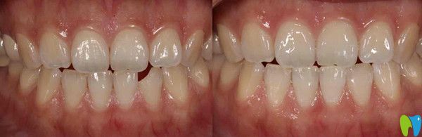 下頜前牙牙體缺損修復(fù)效果圖