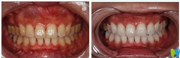 冷光美白前后變化圖
