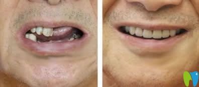 中山好民生口腔黎洪強醫(yī)生多顆牙種植效果