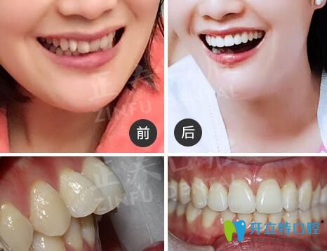 深圳正夫口腔正畸怎么樣？看多組正夫口腔牙齒矯正評價