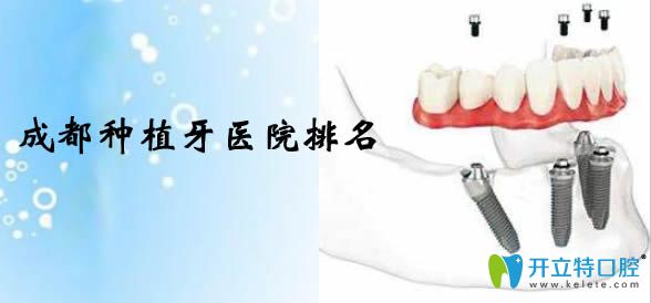今天公布成都種植牙價格表及成都種植牙醫(yī)院排名情況