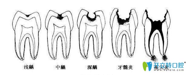牙齒疼痛不一樣是因?yàn)檠缐牡某潭炔灰粯? border=