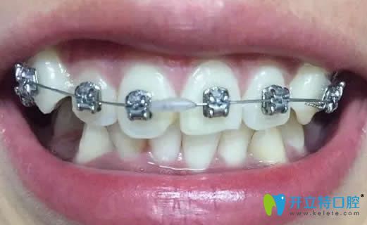 我在昆明王巍口腔做金屬矯正戴牙套第3個月 我在昆明王巍口腔做金屬矯正戴牙套第3個月