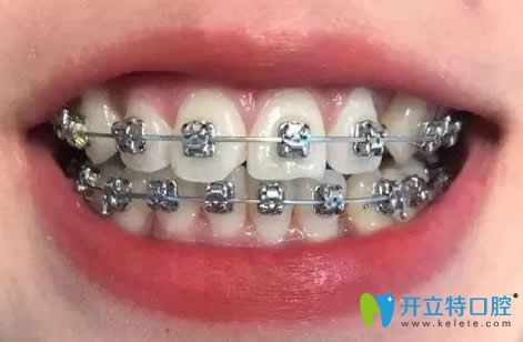 我在昆明王巍口腔做牙齒矯正15個月 我在昆明王巍口腔做牙齒矯正15個月