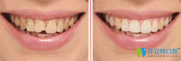 輕度牙齒缺損修復(fù)后對比照