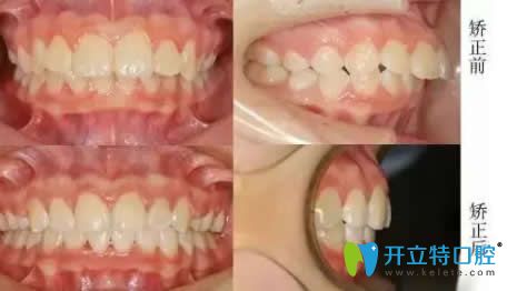 南昌安植雅口腔陳威宏博士齙牙隱形矯正案例 南昌安植雅口腔陳威宏博士齙牙隱形矯正案例