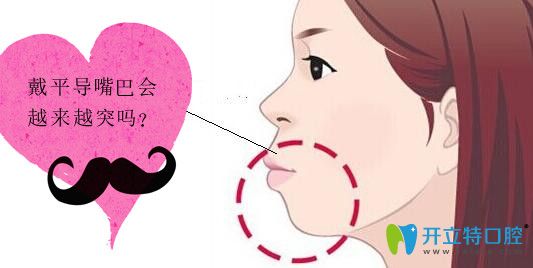 戴了平導(dǎo)上牙越來越突