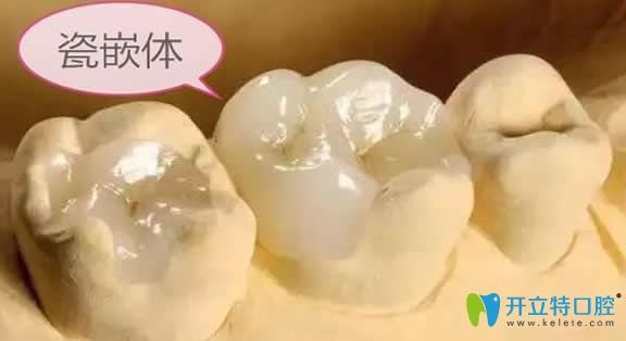 瓷嵌體